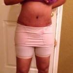Mini tummy tuck pictures before and after New York City top cosmetic surgeons