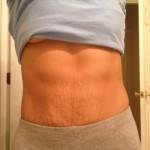 Mini tummy tuck pictures before and after New York top cosmetic surgeons shapshots