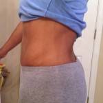 Mini tummy tuck pictures before and after New orleans top best plastic surgeons photos