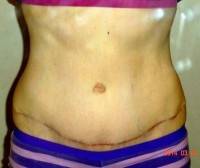 Mini tummy tuck pictures before and after Raleigh NC best cosmetic surgeons images