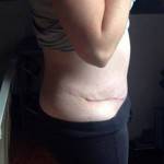 Mini tummy tuck pictures before and after Raleigh NC cosmetic surgeons