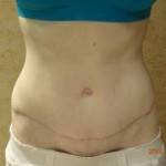 Mini tummy tuck pictures before and after San diego best cosmetic surgeons