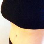 Mini tummy tuck pictures before and after San diego cosmetic surgeons pictures