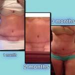 Mini tummy tuck pictures before and after Seattle top best surgeons pics