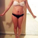 Mini tummy tuck pictures before and after Seattle top plastic surgeons pics