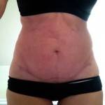 Mini tummy tuck pictures before and after Tampa best cosmetic surgeons photos