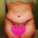 Mini tummy tuck pictures before and after Texas