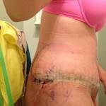 Mini tummy tuck pictures before and after Texas top best plastic surgeons pictures