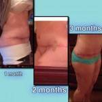 Mini tummy tuck pictures before and after Texas top plastic surgeons photos