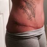 Mini tummy tuck pictures before and after and pregnancy picture
