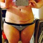 Mini tummy tuck pictures before and after dog ears picture