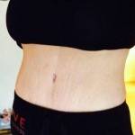 Mini tummy tuck pictures before and after exercise picture