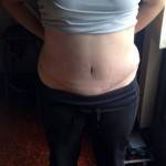 Mini tummy tuck pictures before and after extended