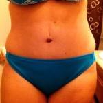 Mini tummy tuck pictures before and after full or mini image