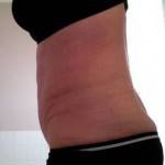 Mini tummy tuck pictures before and after gallery