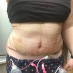 Mini tummy tuck pictures before and after mini images