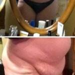 Mini tummy tuck pictures before and after of avelar pics