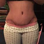 Mini tummy tuck pictures before and after of brazilian shapshot