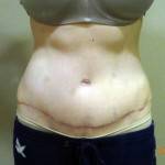 Mini tummy tuck pictures before and after of c section pic