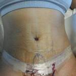 Mini tummy tuck pictures before and after of recovery timeline pics