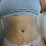 Mini tummy tuck pictures before and after of revision pic