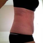 Mini tummy tuck pictures before and after operation photos