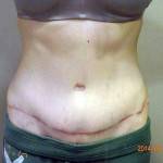 Mini tummy tuck pictures before and after operation pic