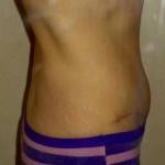 Mini tummy tuck pictures before and after recovery timeline pic
