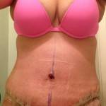 Mini tummy tuck pictures before and after scars recovery snapshots