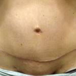 Mini tummy tuck pictures before and after stretch marks image