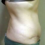 Mini tummy tuck pictures before and after stretch marks pic