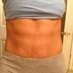 Mini tummy tuck pictures before and after stretch marks shapshot