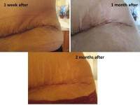 Tummy tuck images Atlanta best cosmetic surgeons shapshots