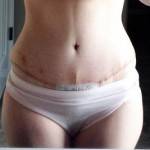 Photos of tummy tuck Baltimore cosmetic surgeons pictures