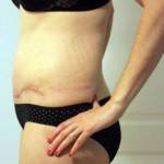 Photos of tummy tuck Charlotte nc surgeons pictures