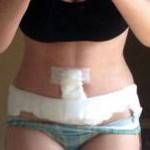 Photos of tummy tuck Dallas top best surgeons pictures