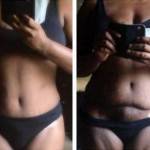 Photos of tummy tuck Miami top best surgeons images