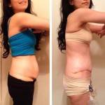 Photos of tummy tuck New York top best cosmetic surgeons photos