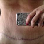 Photos of tummy tuck New orleans cosmetic surgeons images