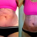 Photos of tummy tuck Raleigh NC best cosmetic surgeons shapshots