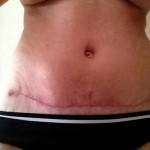 Photos of tummy tuck San diego top best plastic surgeons pictures