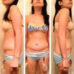 Photos of tummy tuck after birth