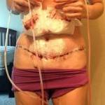 Photos of tummy tuck and lipo surgery pictures