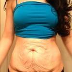 Photos of tummy tuck and liposuction operation picture