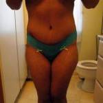 Photos of tummy tuck liposuction photos