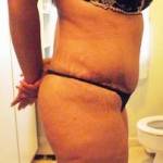 Photos of tummy tuck liposuction pic