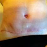 Photos of tummy tuck nyc cosmetic surgeons images