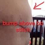 Photos of tummy tuck of partial