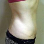 Photos of tummy tuck of scar treatment image