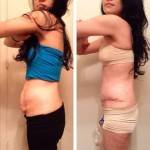 Photos of tummy tuck of scar treatment pictures